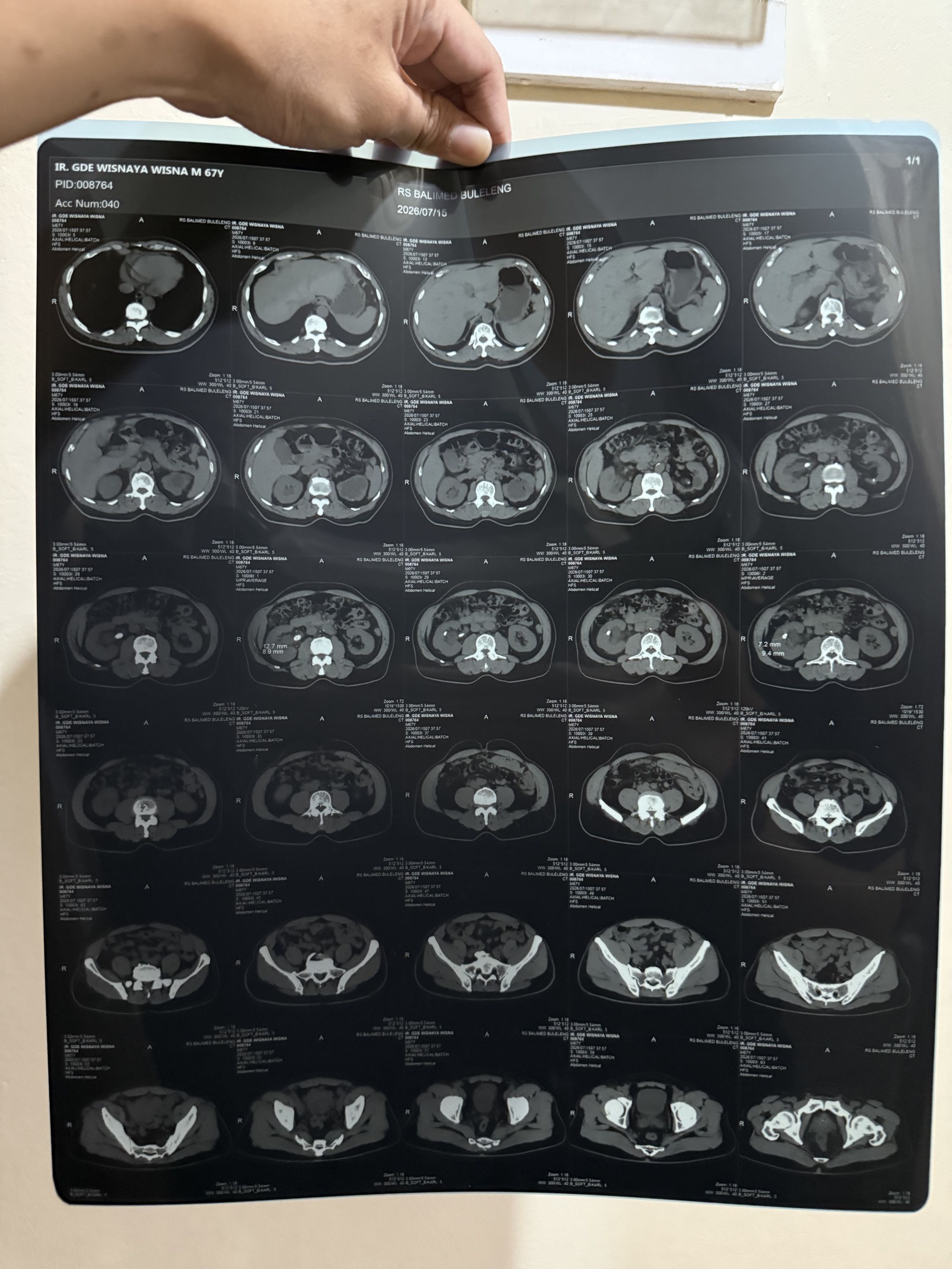 CT Axial - Gde Wisnaya Wisna